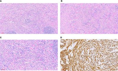 Inflammatory myofibroblastic tumor of the thyroid gland